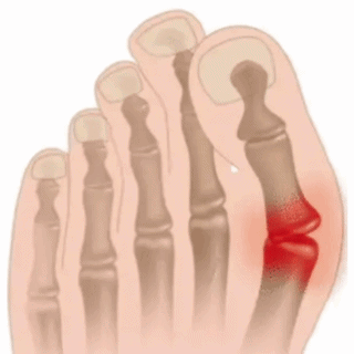 Reduce inflamatia